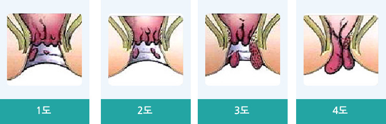 내치핵의 1도, 2도, 3도, 4도 의 이미지