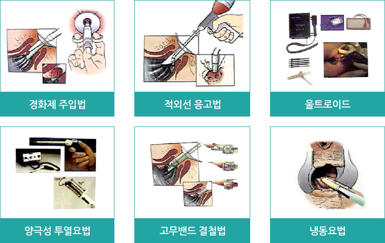 비수술적 치료 > 치핵의 비수술적 치료법들 : 경화제 주입법, 적외선 응고법, 울트로이드, 양극성 투열요법, 고무밴드 결철법, 냉동요법 의 이미지