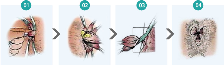 근본치료 > 개방 치핵 절제수술의 1,2,3,4 순서 이미지