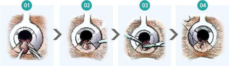 근본치료 > 폐쇄 치핵 절제수술의 1,2,3,4 순서 이미지