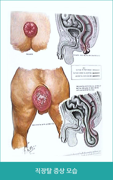 비수술적 치료 > 치핵의 비수술적 치료법들 : 경화제 주입법, 적외선 응고법, 울트로이드, 양극성 투열요법, 고무밴드 결철법, 냉동요법 의 이미지