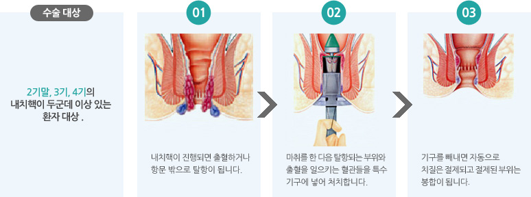 수술대상(2기말, 3기, 4기의 내치핵이 두군데 이상 있는 환자 대상) : 1. 내치핵이 진행되면 출혈하거나 항문 밖으로 탈항이 됩니다. 2. 마취를 한 다음 탈항되는 부위와 출혈을 일으키는 혈관들을 특수기구에 넣어 처치합니다. 3. 기구를 빼내면 자동으로 치질은 절제되고 절제된 부위는 봉합이 됩니다.