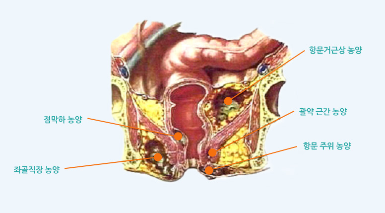 항문직장 농양의 종류의 점막하 농양, 좌골직장 농양, 항문거근 농양, 괄약 근간 농양, 항문 주위 농양의 이미지