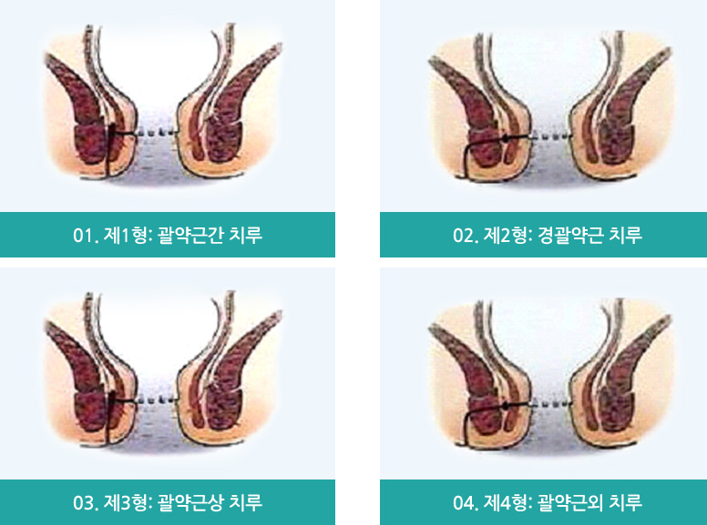 괄약근과의 관계에 따른 분류 : 01. 제1형 괄약근간 치루, 02. 제2형 경괄약근 치루, 03. 제3형 : 괄약근상 치루, 04. 제4형 : 괄약근외 치루 의 이미지