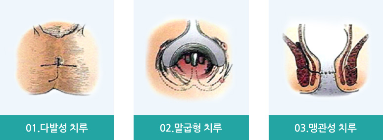 생긴모양에 따른 분류의 01. 다발성 치루, 02. 말굽형 치루, 03. 맹관성 치루의 이미지