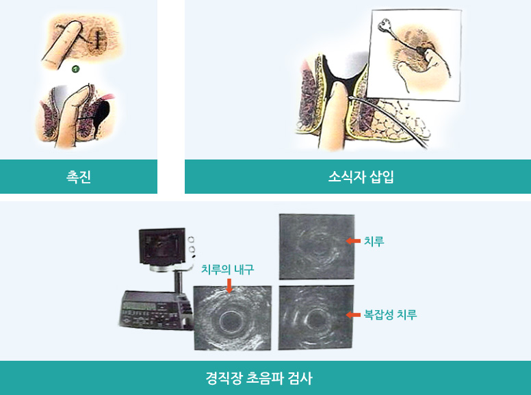 치루의 치료방법 : 촉진, 소식자 삽입, 경직장 초음파 검사의 이미지